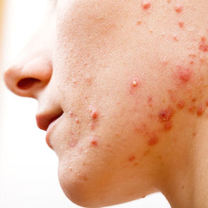 Acne Treatment Glen Mills, PA | Acne Care Services Delaware County